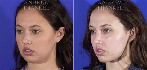 buccal fat reduction scottsdale|Dr. Scottsdale® .
